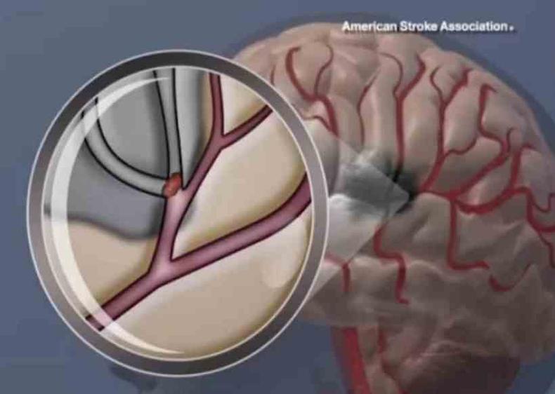 Exame para detectar possibilidade de AVC