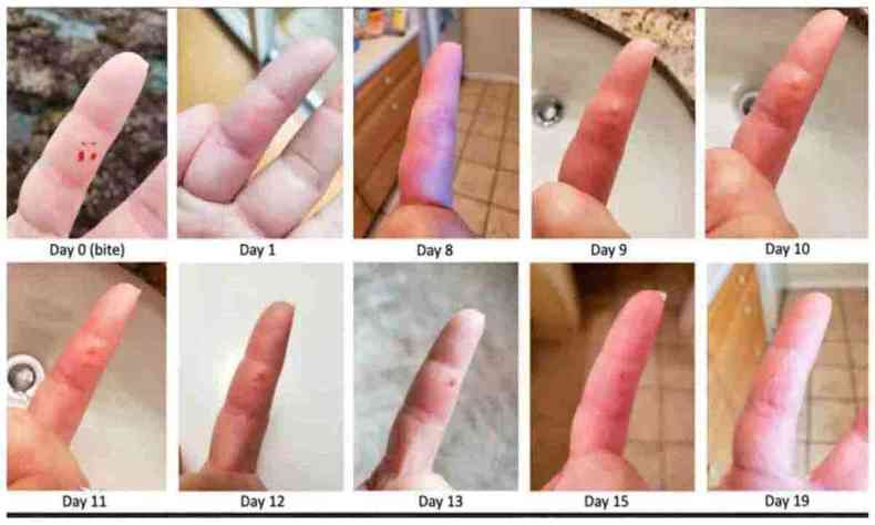Inchao gradativo de um dedo mordido em 19 dias