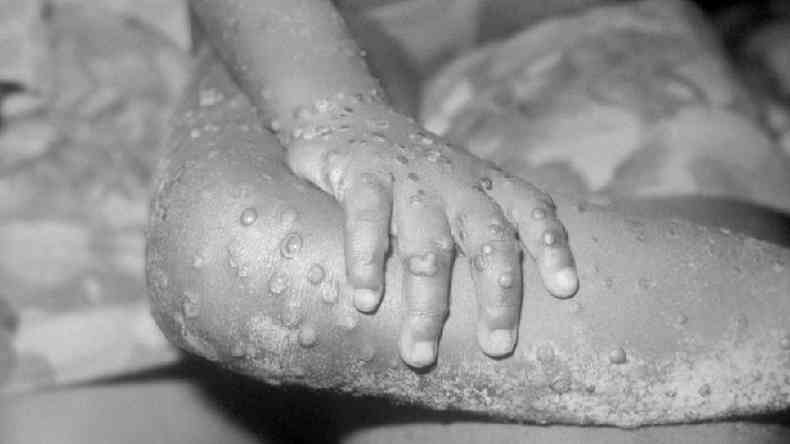 Os braços e pernas de uma menina de 4 anos com varíola dos macacos na Libéria
