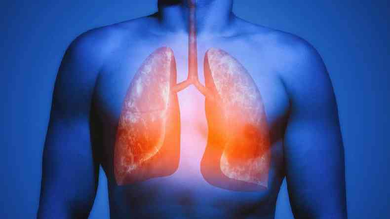 COVID-19 pode deixar problemas crônicos nos pulmões e outros órgãos, como a fibrose pulmonar(foto: Getty Images)