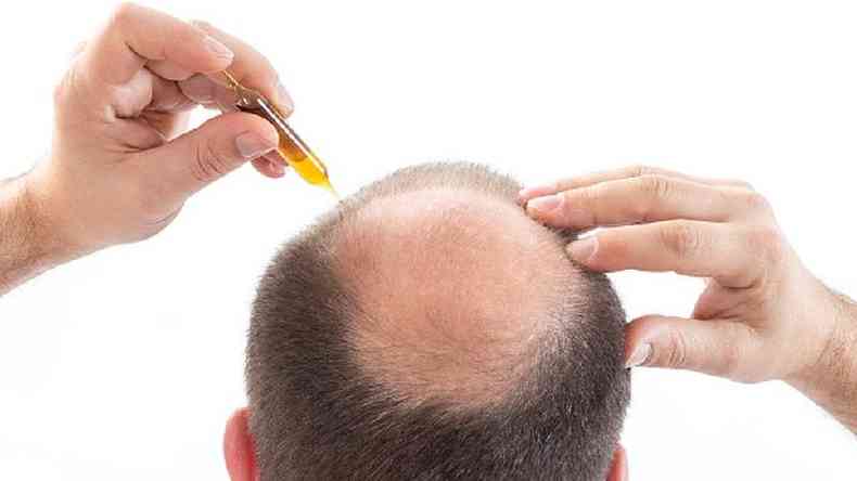Homem com alopecia aplica ampola com um produto na cabea