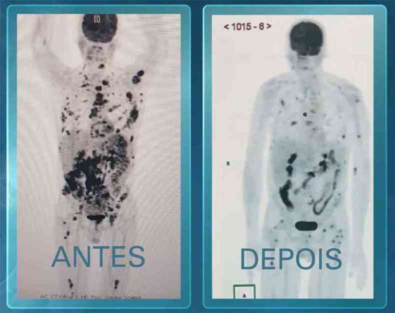 Exames de imagem mostram paciente quando chegou ao hospital e regresso da doena depois da terapia (foto: Fantstico/Reproduo)