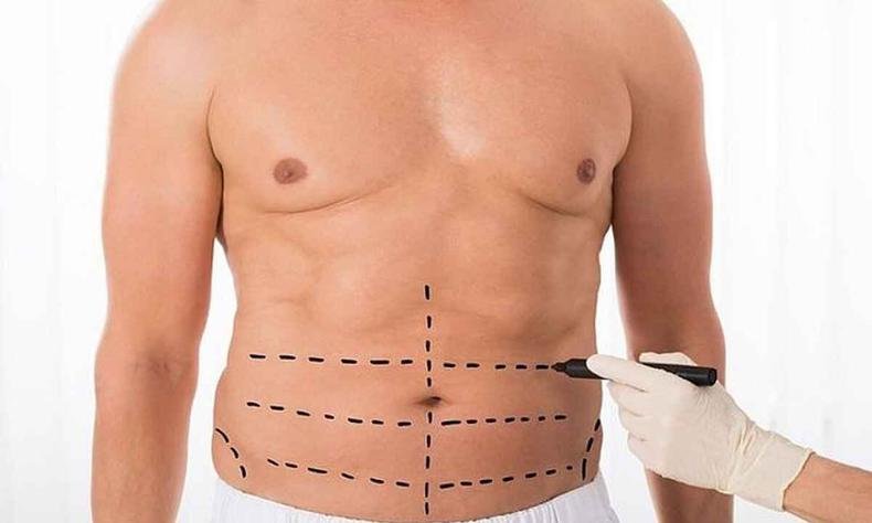 Homens brasileiros têm procurado procedimentos como a lipoaspiração(foto: Reprodução) Foto mostra barriga masculina com marcas feitas à caneta de locais a serem submetidos a lipoaspiração