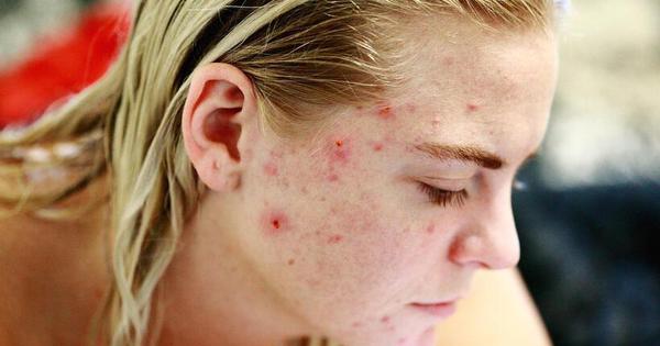 Você espreme cravos e espinhas? Entenda os riscos e o prejuízo à pele