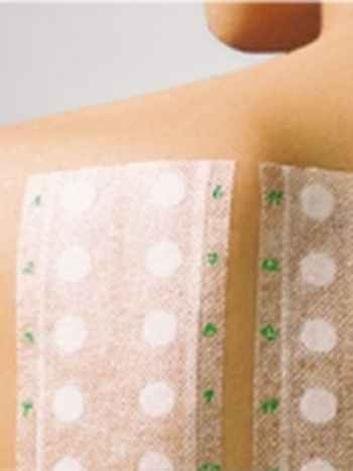 teste de alergia no bra�o, com v�rias subst�ncias colocadas nas costas