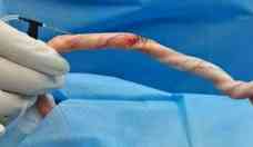 Tecido artificial restaura lesões penianas e recupera função erétil