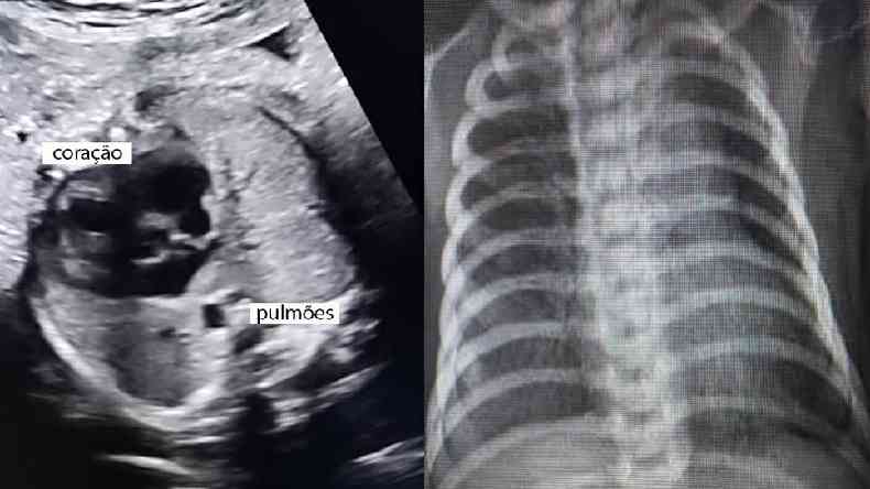 Imagens de ultrassom e raio-x torácico (feito após o nascimento do bebê) não indicam mais a presença do tumor