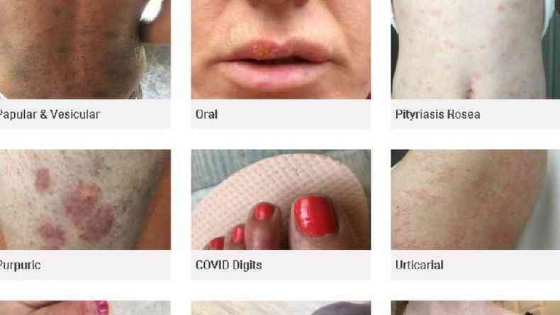 Cientistas do King's College London montaram um banco de imagens online com manifestaes dermatolgicas pelo coronavrus(foto: Reproduo)