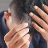Saiba como tratar a alopecia areata com apenas três ingredientes