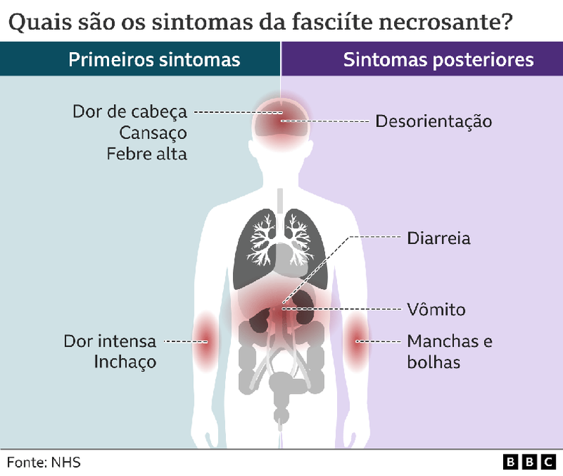 Infogrfico mostra sintomas da fasciite necrosante