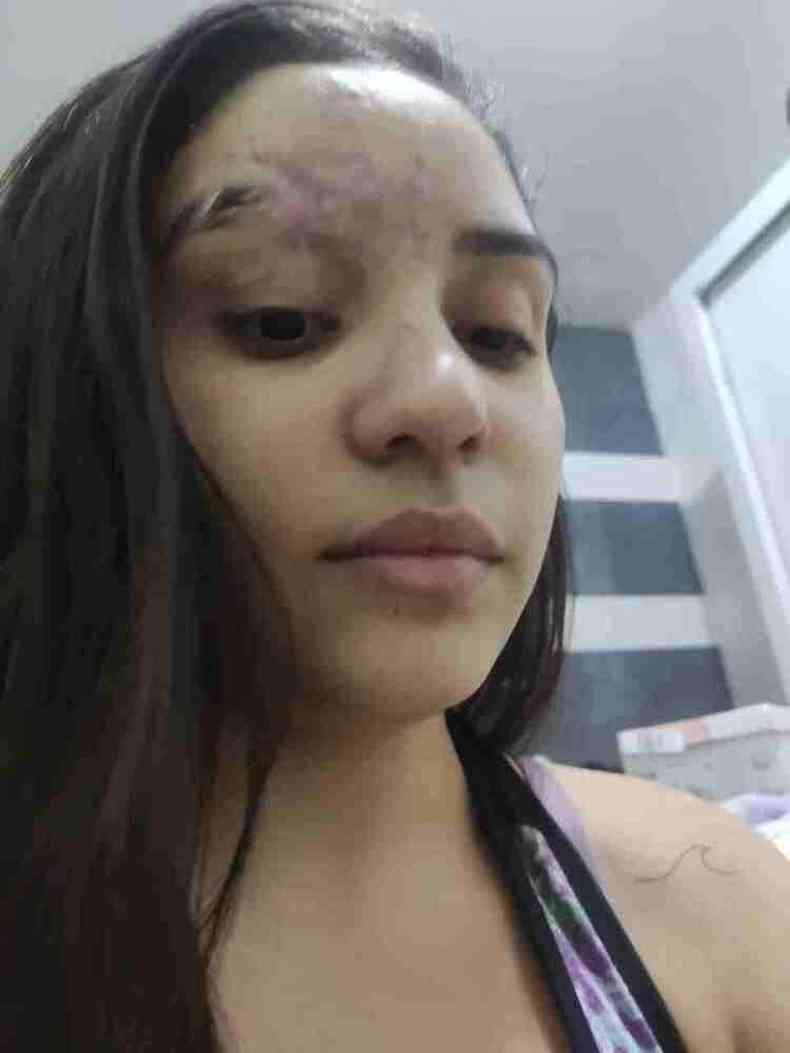 Rosto da estudante ficou marcado por cicatrizes e falhas. Ela no conseguia sair de casa e nem se ver no espelho (foto: Kedydja Borges)