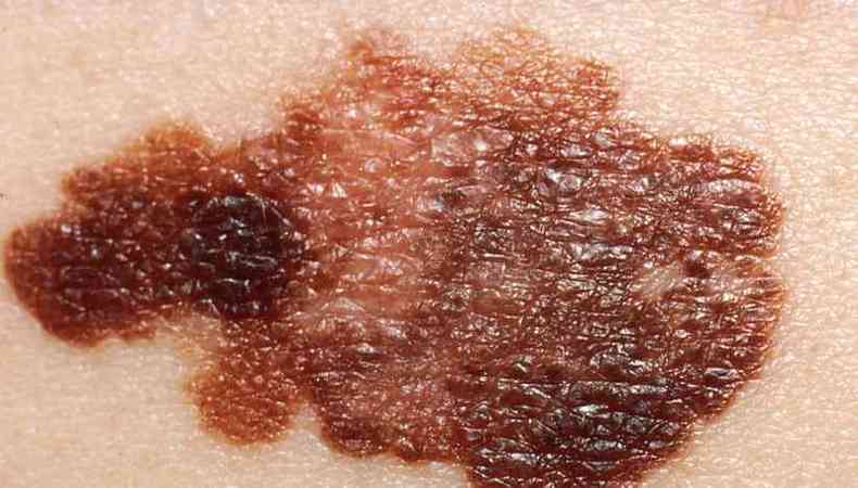 Exemplo de melanoma (foto: National Cncer Institute/reproduo)