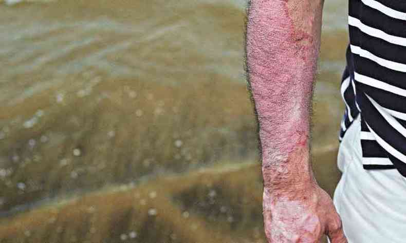 Pacientes sofrem preconceito por causa das leses aparentes na pele(foto: Ralf Tooten Photographer/Pfizer)