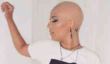 Cabeleireira mineira com alopecia fica careca: 'Perdi os fios e clientes'