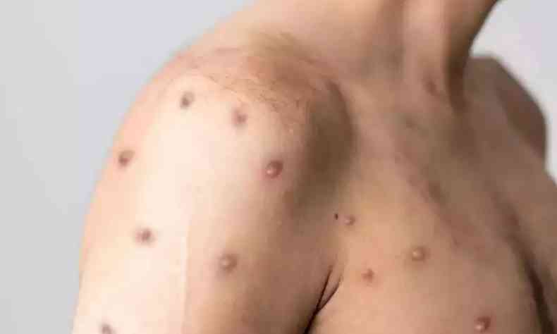 Na foto,  possvel ver manchas na pele, sintoma da varola dos macacos, em corpo de homem