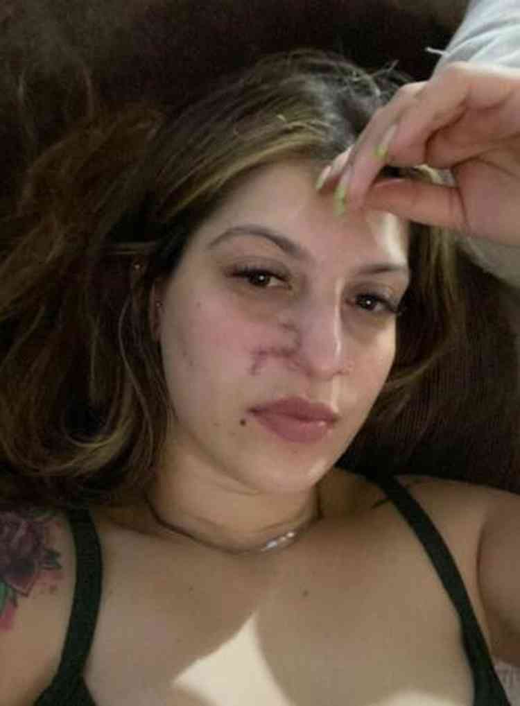 Daiane Lima com cicatriz durante a recuperao da cirurgia