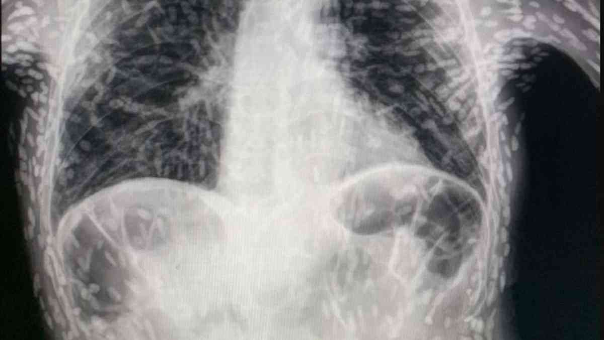 Un médico muestra una radiografía a un paciente con tenias en todo el cuerpo y las preocupaciones de Internet
