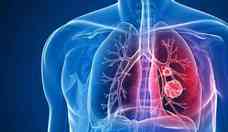 Especialista alerta para riscos da tuberculose pulmonar no tratada