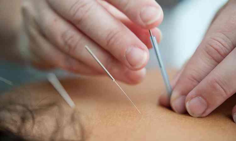 Agulhas de acupuntura sendo aplicadas nas costas de uma paciente