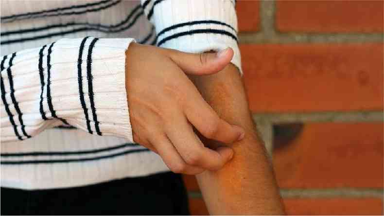 Em estudo do King's College London, no Reino Unido, 21% das pessoas disseram que sinais dermatolgicos foram os nicos sinais clnicos da covid-19(foto: Getty Images)