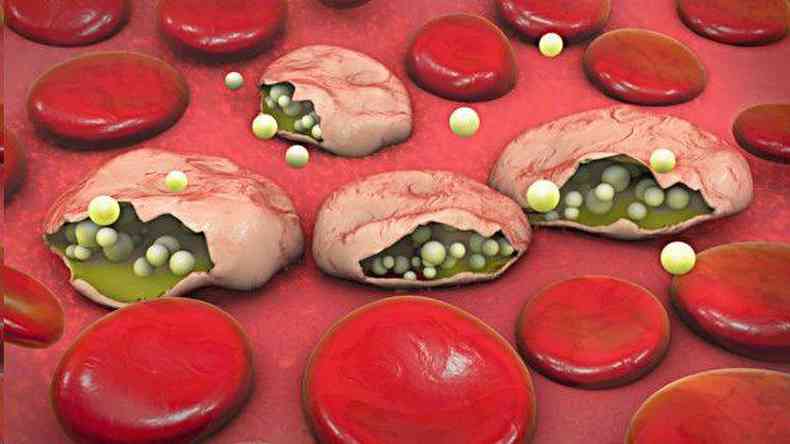 Ilustrao mostra hemceas infectadas por parasita da malria(foto: Getty Images)
