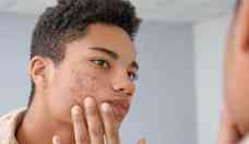 Cicatriz de acne aparece mais em homem com caso grave da doena