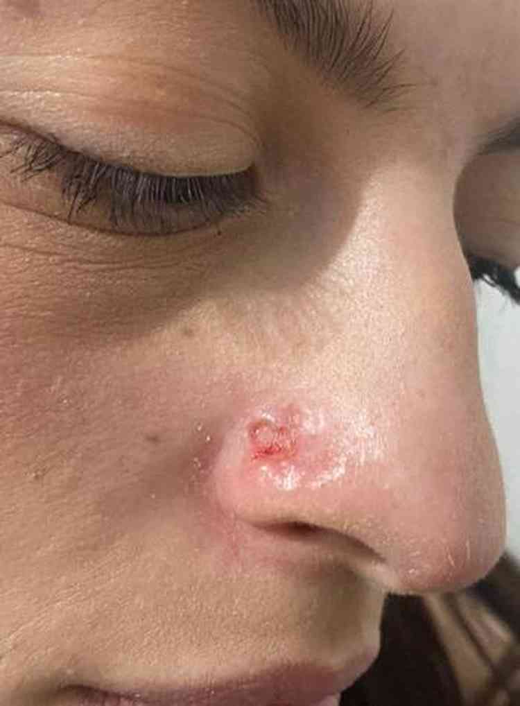 Daiane Lima com ferida no nariz antes do diagnstico