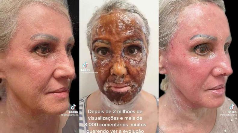 Procedimento é agressivo e requer cuidado(foto: Reprodução Redes Sociais ) Montagem de momento dos videos