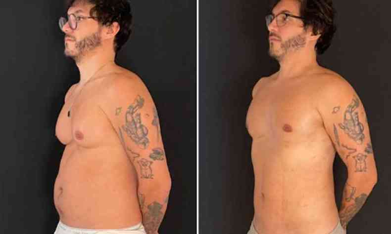 Ex-BBB Eliezer, de 33 anos, mostra resultado da cirurgia de ginecomastia para diminuir as mamas