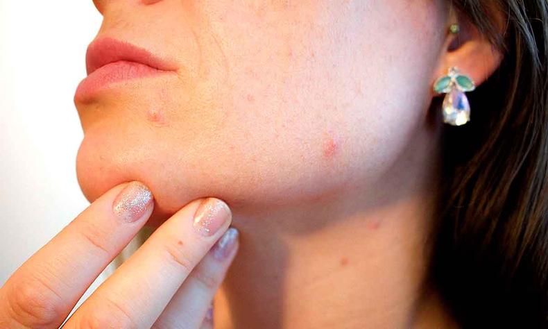 (foto: CFN/CRN/Divulgação) Acne
