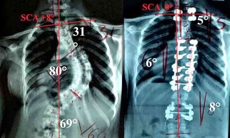 Radiografias do antes e depois de cirurgia de escoliose com a aplicação do estudo do ângulo sacro-clavicular