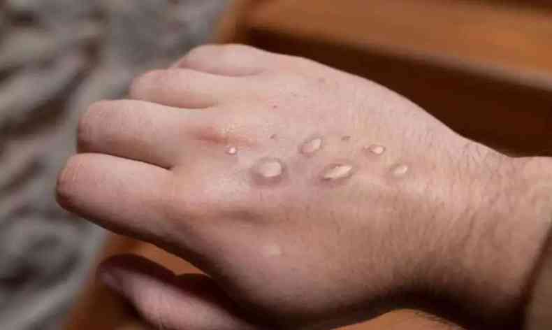 Manchas na pele causadas pela monkeypox