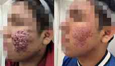 Tratamento esttico para acne severa viraliza; conhea opes