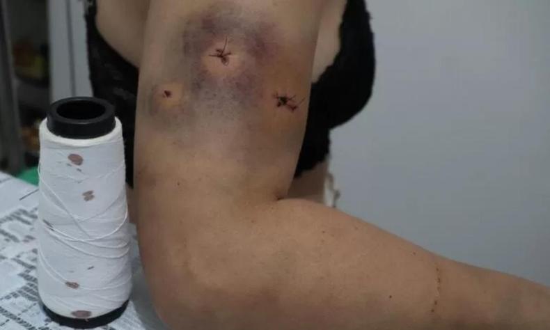 Brao da vitima com hematomas e furos, ao lado um carretel de linha 