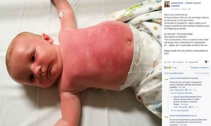 Jessie postou uma foto do bebê com manchas avermelhadas no tórax, nos braços e no rosto(foto: Cancer Council Australia/Facebook ) Jessie postou uma foto do bebê com manchas avermelhadas no tórax, nos braços e no rosto(foto: Cancer Council Australia/Facebook )