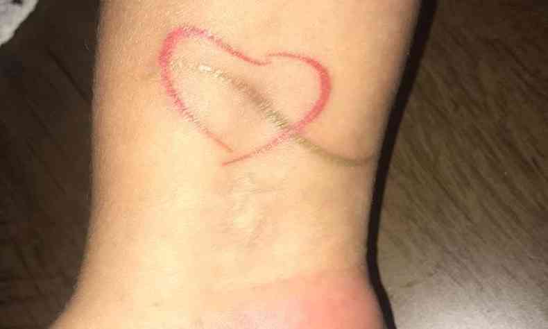 Aps um ano do diagnstico de cncer, paciente tatua logomarca do hospital Felcio Rocho(foto: Arquivo pessoal)