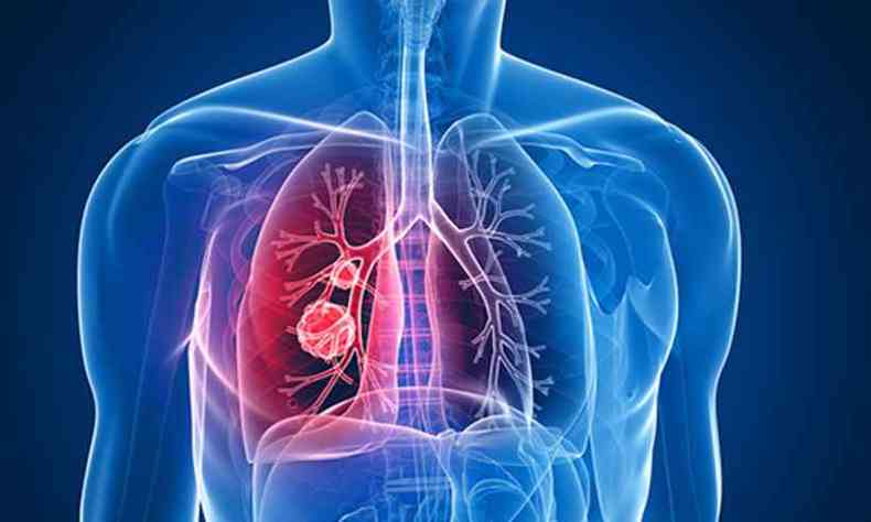 cncer de pulmo  um dos mais comuns no Brasil (foto: Sobrice/reproduo)