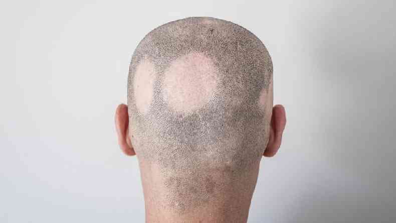 Pacientes com predisposio gentica ou doenas autoimunes, por exemplo, que podem apresentar quedas em forma de rodelas, condio conhecida como alopecia areata(foto: Getty Images)