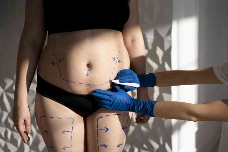 Mulher branca com top e calcinha pretos sendo examinada para realizao de procedimento cirrgico com marcaes no abdome por um profissional
