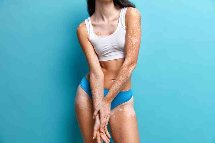 mulher de top e calcinha mostra braos e pernas com vitiligo, no aparece o rosto