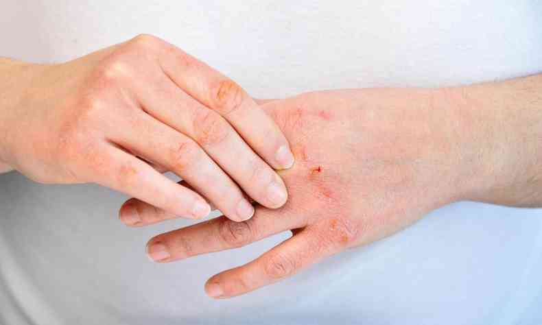 Mos feridas de paciente que apresenta a doena dermatite de contato