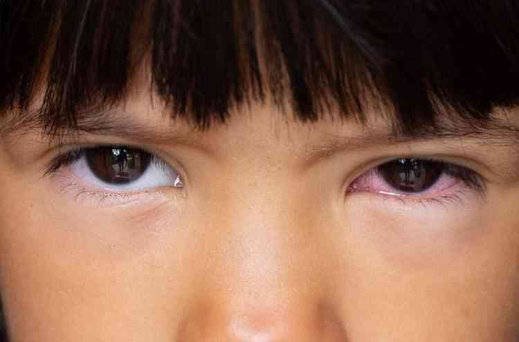 Caso os sintomas persistam,  importante procurar um mdico oftalmologista