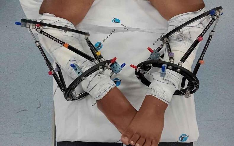 Cirurgia para correção de pernas arqueadas (foto: Hospital da Baleia/Divulgação) Cirurgia para correção de pernas arqueadas
