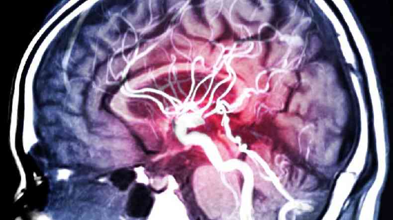Em um acidente vascular cerebral tpico, os vasos sanguneos so bloqueados e sintomas aparecem(foto: Getty Images)