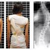 Escoliose em crianças e adolescentes? Especialista alerta para tratamentos