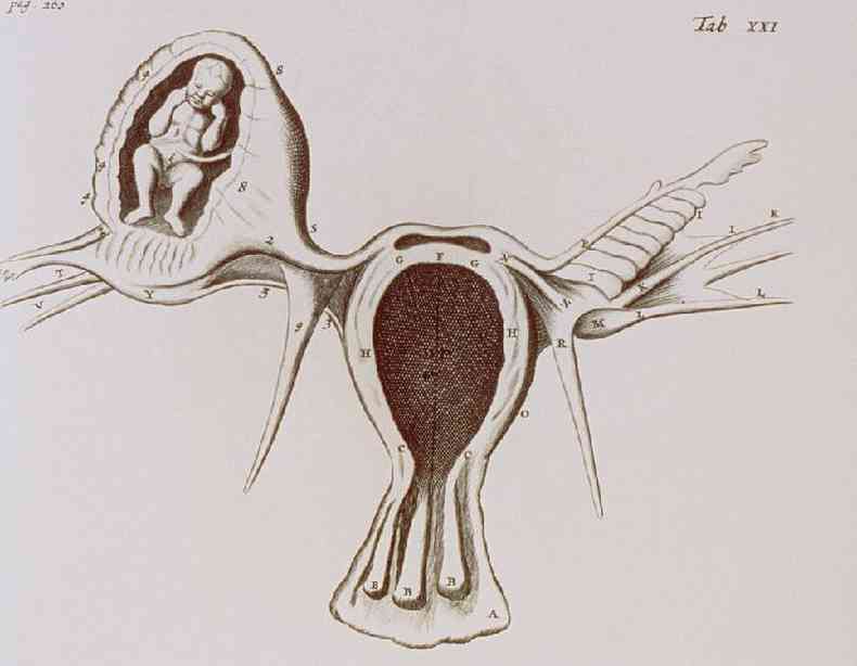 Ilustração de uma gravidez ectópica de um livro de Medicina