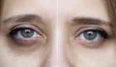 10 perguntas sobre preenchimento de olheiras usando cido hialurnico 