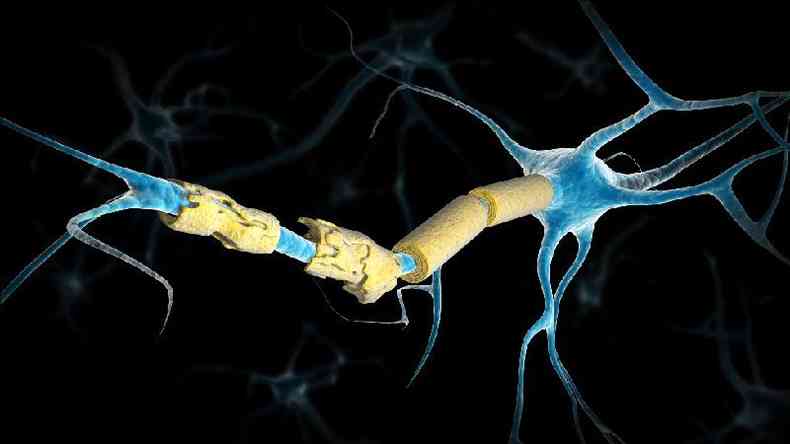 Ilustração de mielina danificada em um neurônio de uma pessoa com esclerose múltipla