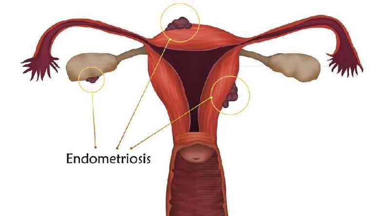 Grfico mostrando a endometriose