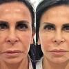 Gretchen e outras celebridades apostam na harmonização facial